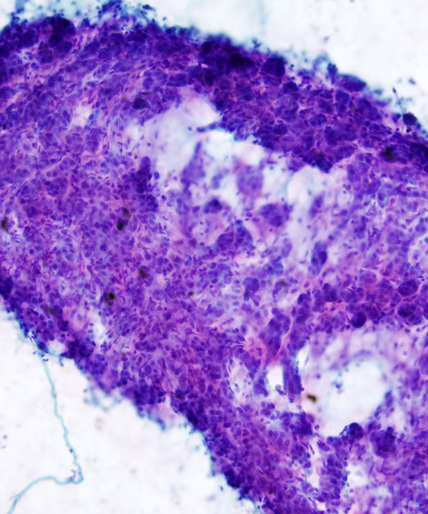 image showing 'Adrenocortical Adenoma / Hyperplasia'