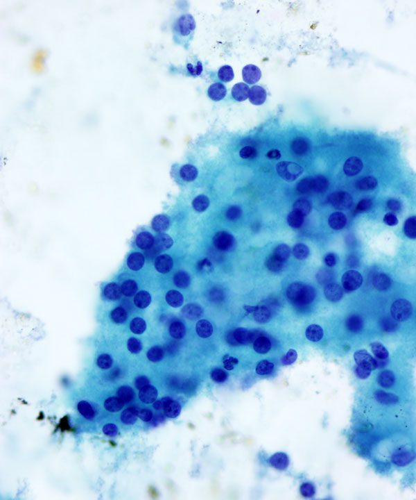 02: Adrenal Gland Adenoma / Hyperplasia