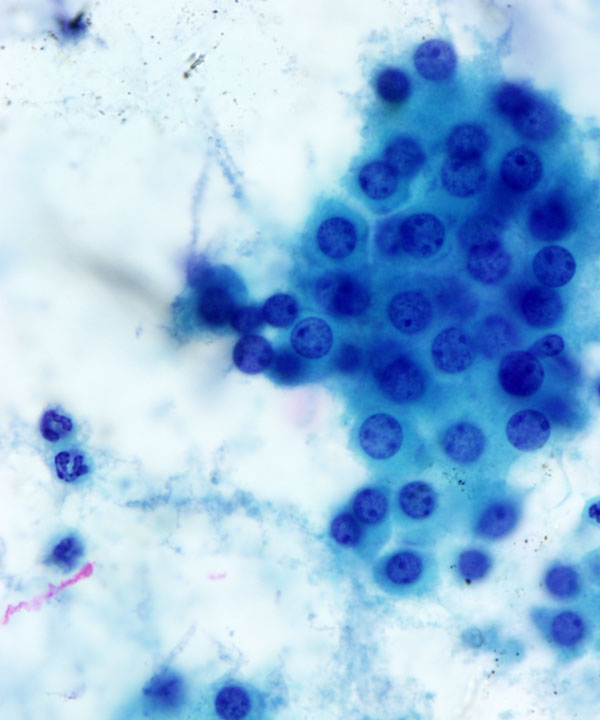 04: Adrenal Gland Adenoma / Hyperplasia