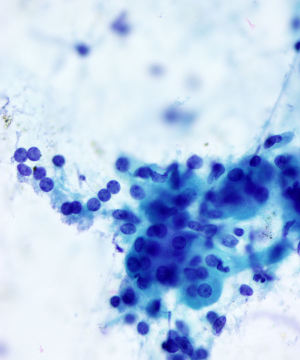 03: Adrenal Gland Adenoma / Hyperplasia