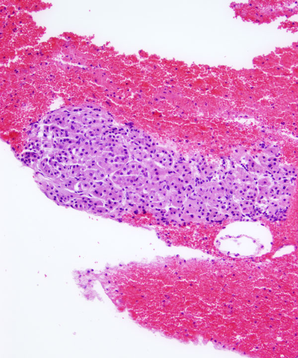 05: Adrenal Gland Adenoma / Hyperplasia