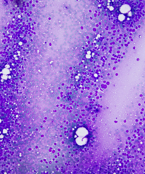 image showing 'Adrenocortical Carcinoma'