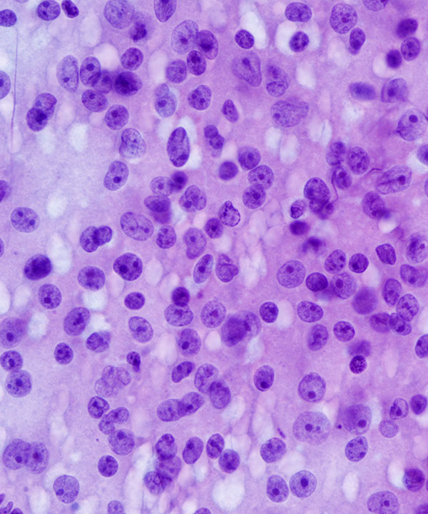 04 : Adrenal Gland Adrenocortical Carcinoma