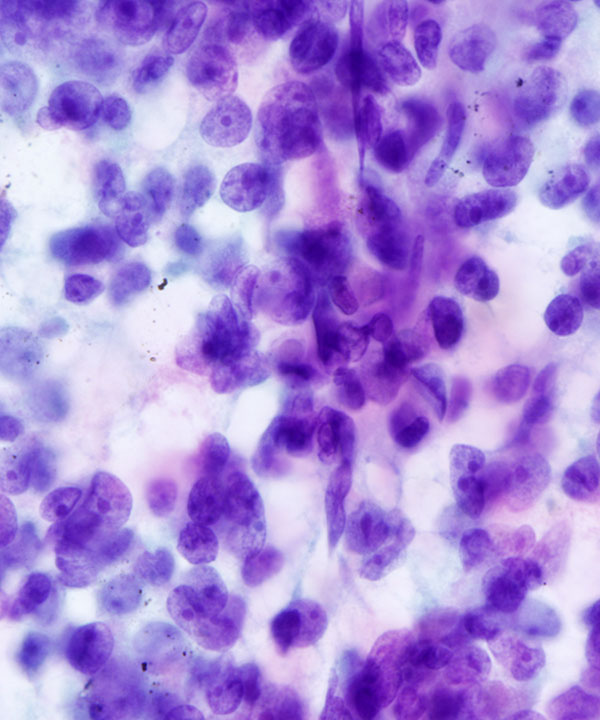 05 : Adrenal Gland Adrenocortical Carcinoma