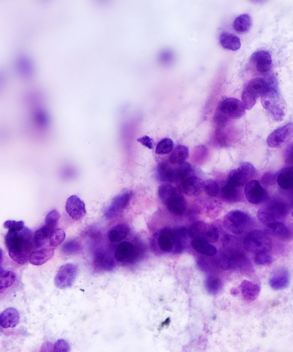 06 : Adrenal Gland Adrenocortical Carcinoma