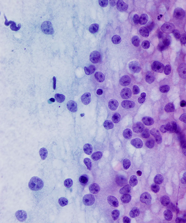 07 : Adrenal Gland Adrenocortical Carcinoma