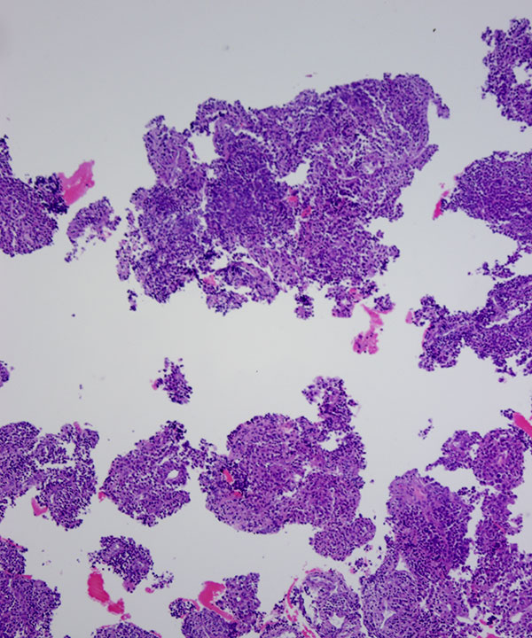 08 : Adrenal Gland Adrenocortical Carcinoma