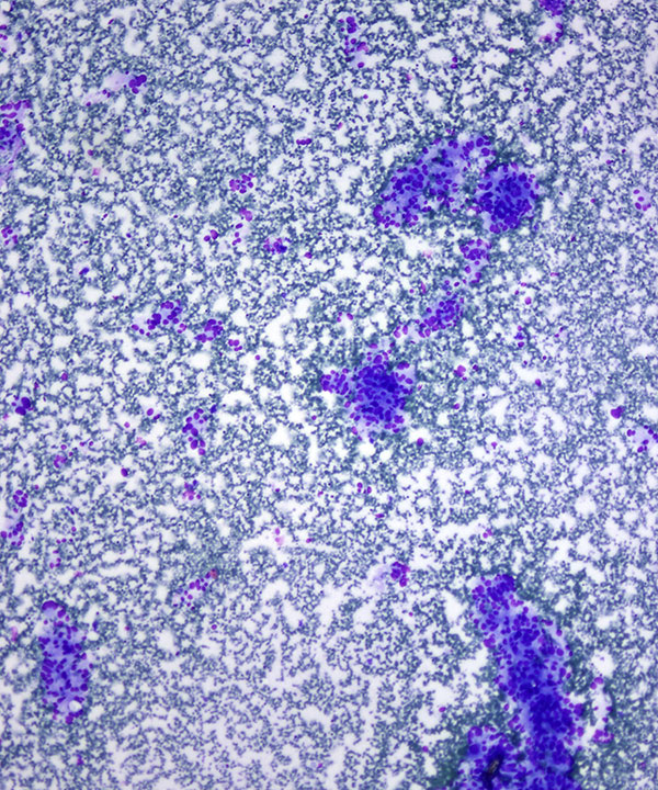 image showing 'Pheochromocytoma'
