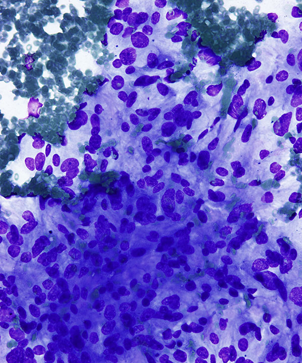 02 : Adrenal Gland Pheochromocytoma