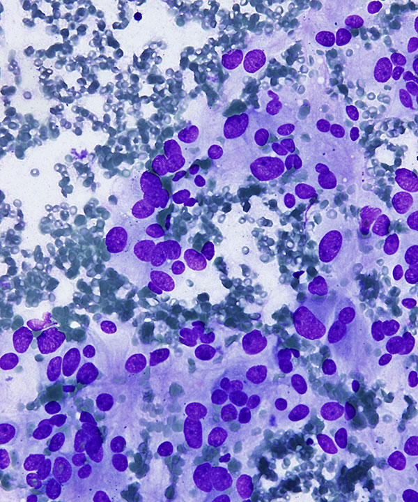 03 : Adrenal Gland Pheochromocytoma