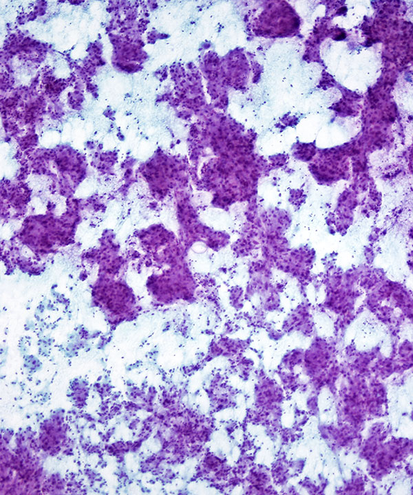 04 : Adrenal Gland Pheochromocytoma