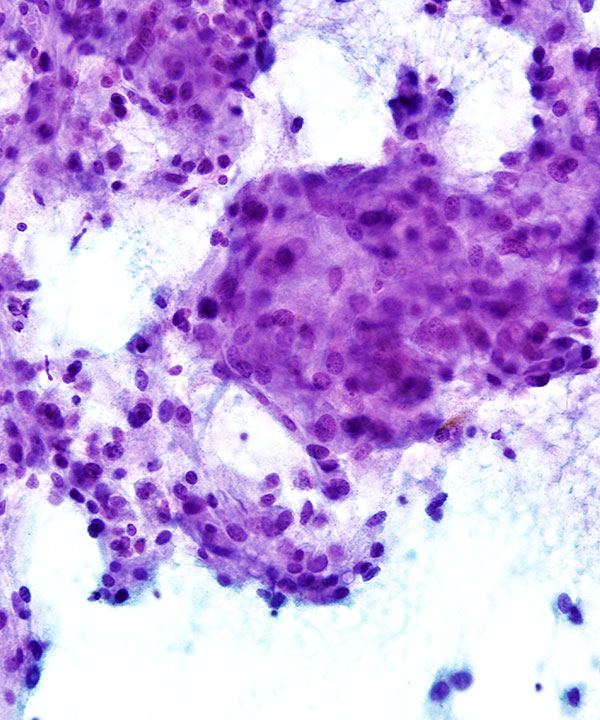 06 : Adrenal Gland Pheochromocytoma