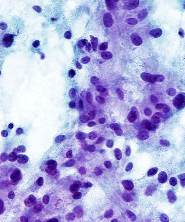 07 : Adrenal Gland Pheochromocytoma