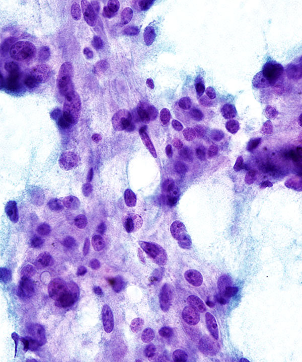 08 : Adrenal Gland Pheochromocytoma