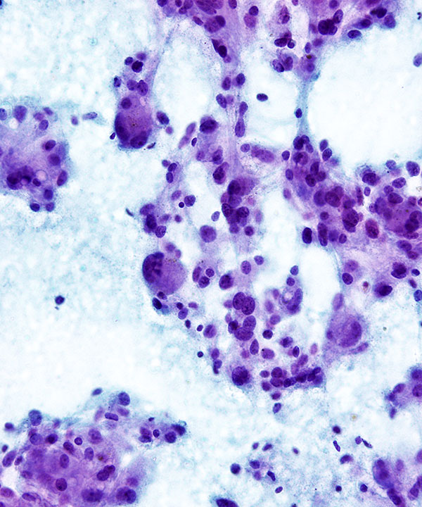 05 : Adrenal Gland Pheochromocytoma