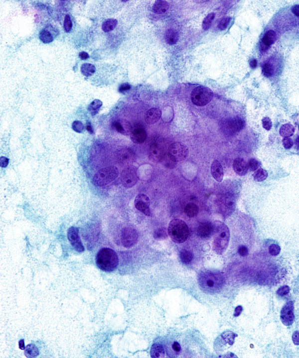 09 : Adrenal Gland Pheochromocytoma