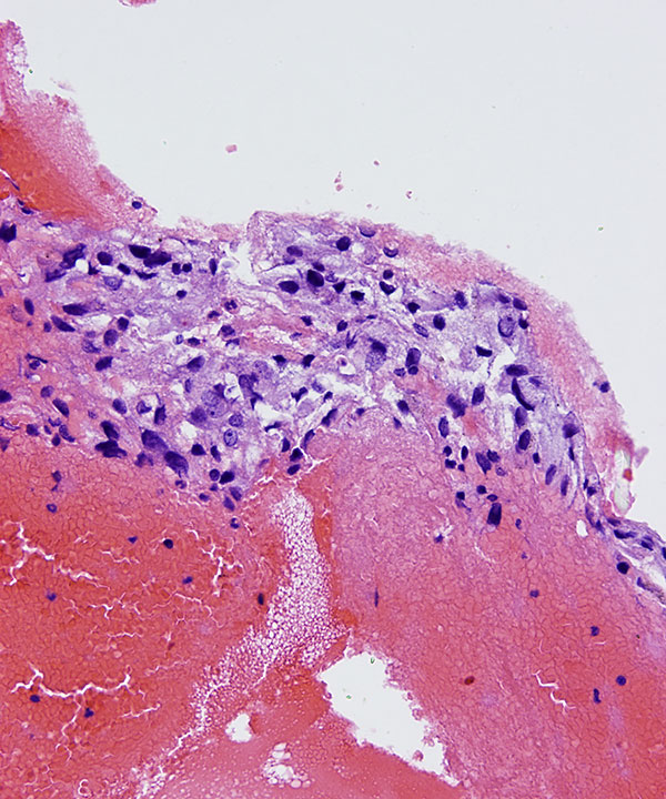 10 : Adrenal Gland Pheochromocytoma