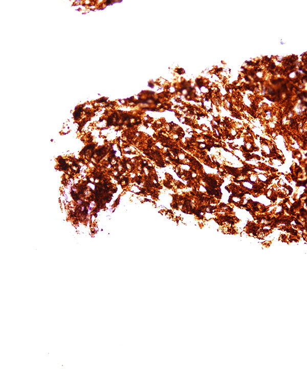 11 : Adrenal Gland Pheochromocytoma