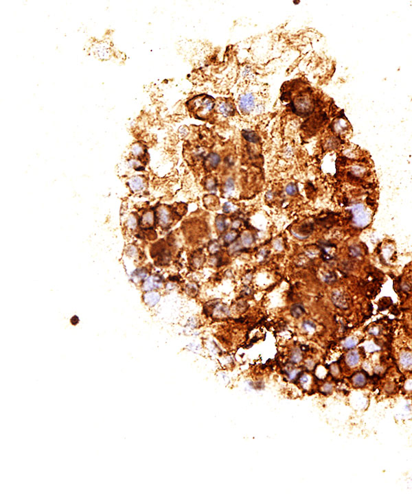 12 : Adrenal Gland Pheochromocytoma