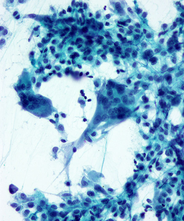 2 : Bone Giant Cell Tumor