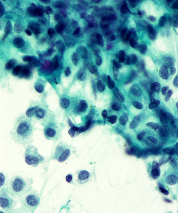 4 : Bone Giant Cell Tumor