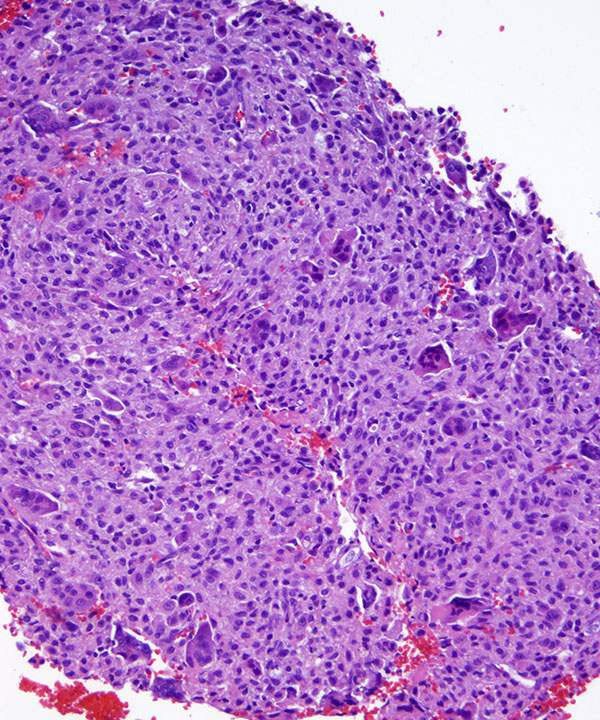 5 : Bone Giant Cell Tumor