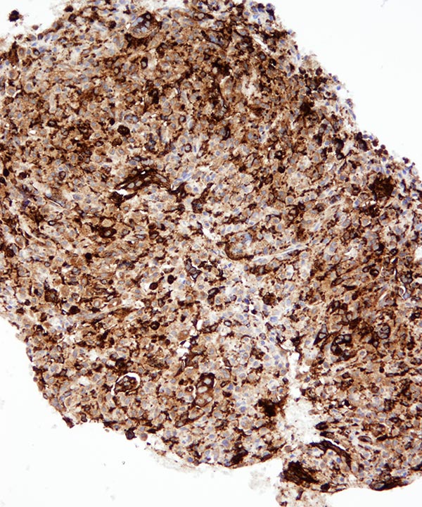 6 : Bone Giant Cell Tumor
