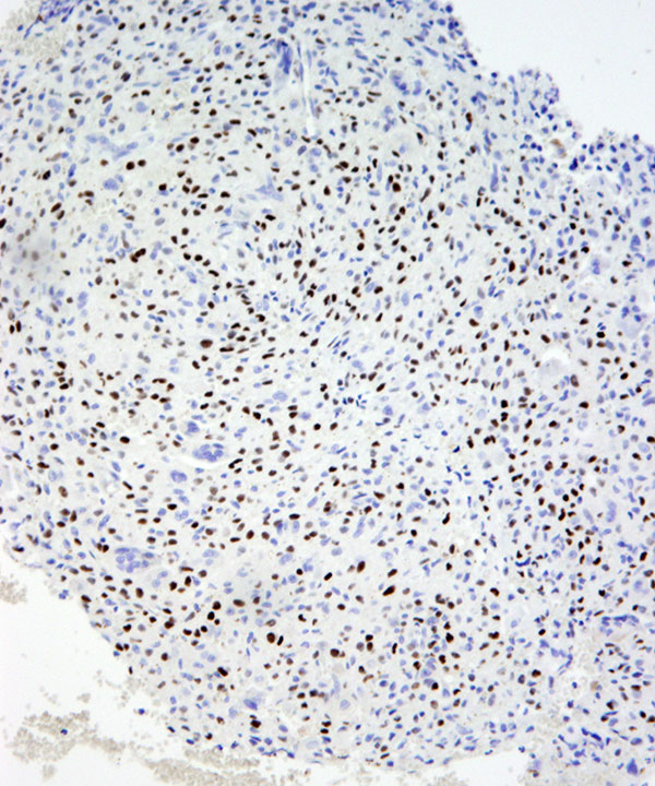 7 : Bone Giant Cell Tumor