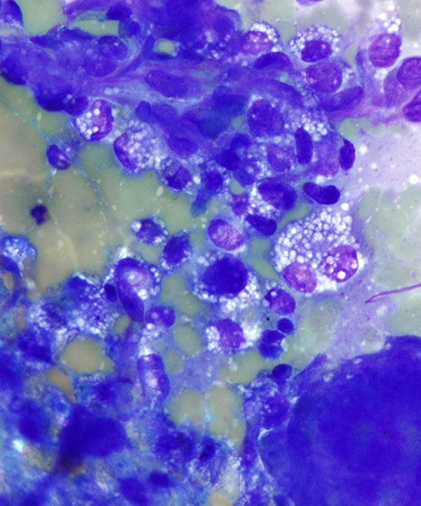 3 : Bone Giant Cell Tumor