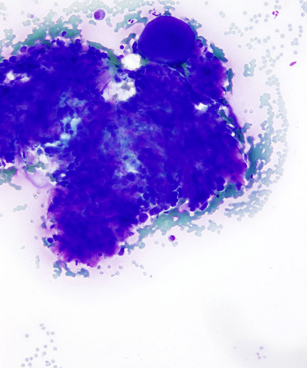 01 : Bone  Soft Tissue Chondroblastoma