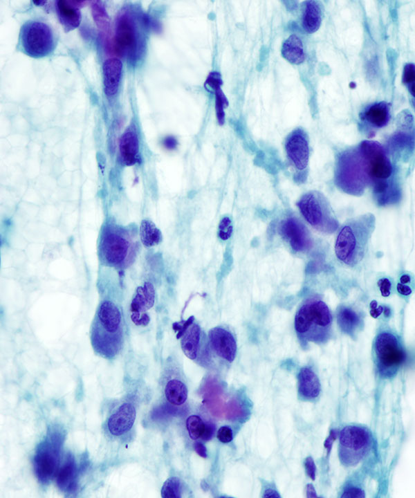 04 : Bone  Soft Tissue Chondroblastoma