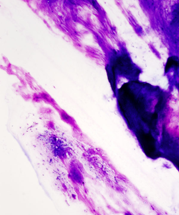 image showing 'Chondrosarcoma'