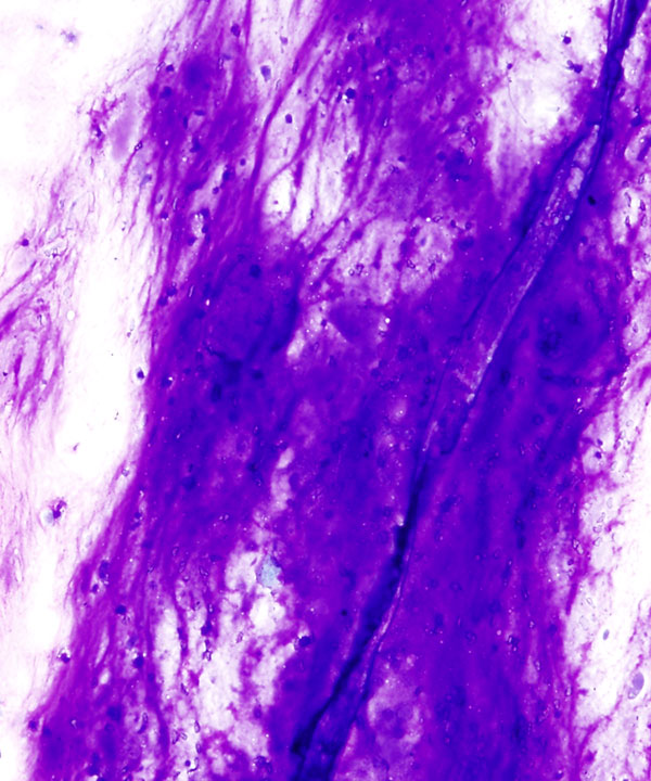 02 : Bone Soft Tissue Chondrosarcoma