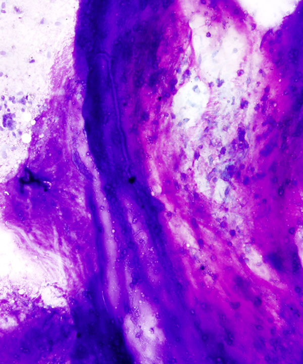 03 : Bone Soft Tissue Chondrosarcoma