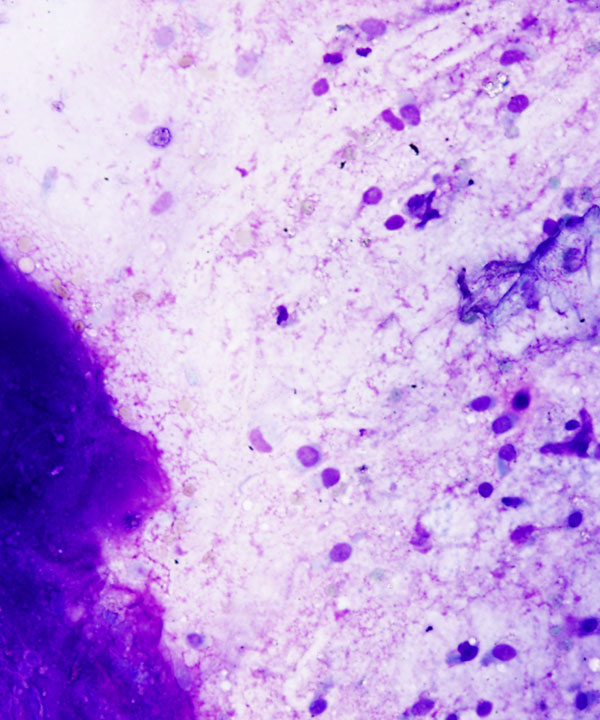 04 : Bone Soft Tissue Chondrosarcoma