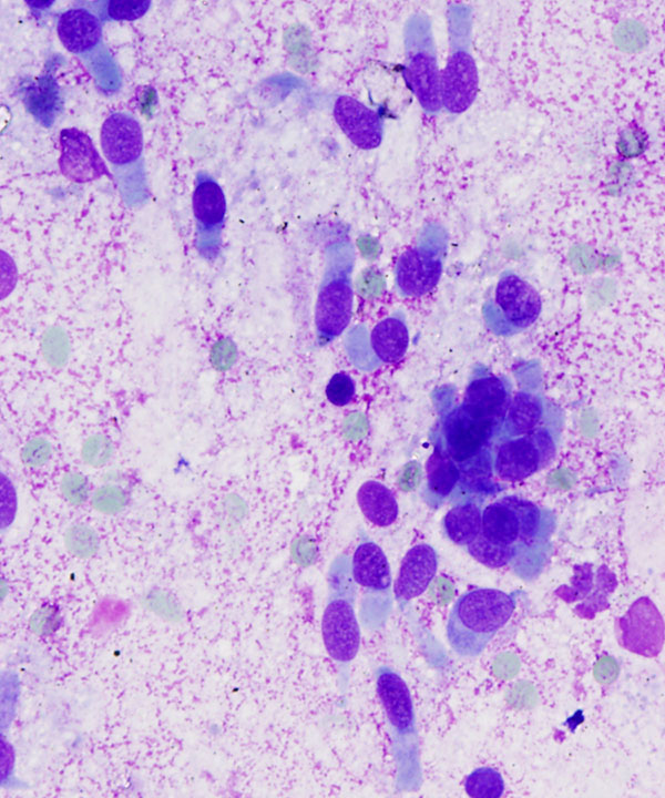 05 : Bone Soft Tissue Chondrosarcoma