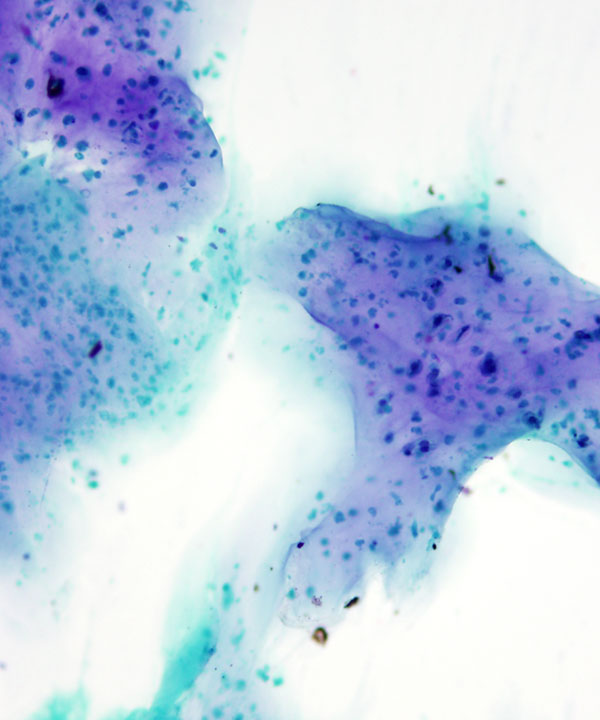 06 : Bone Soft Tissue Chondrosarcoma