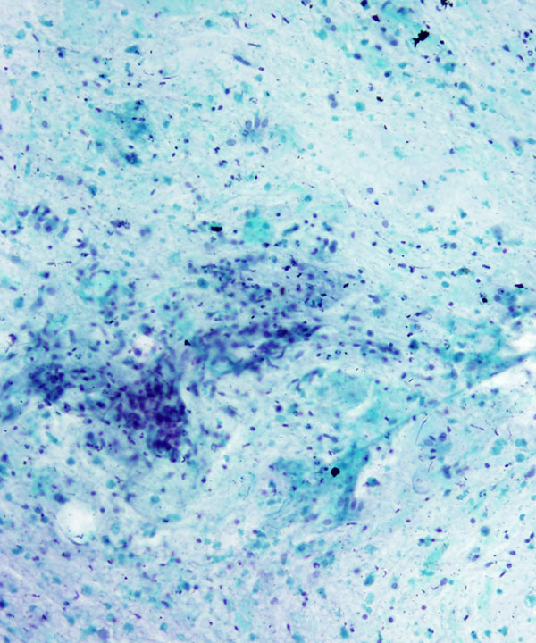 07 : Bone Soft Tissue Chondrosarcoma