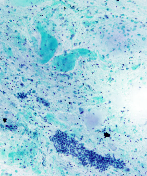 08 : Bone Soft Tissue Chondrosarcoma