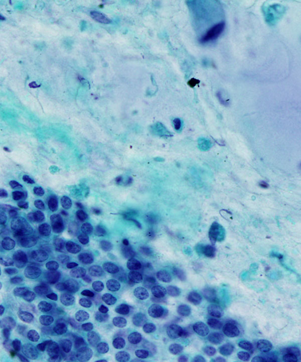 09 : Bone Soft Tissue Chondrosarcoma