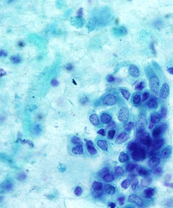 11 : Bone Soft Tissue Chondrosarcoma