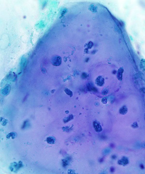 13 : Bone Soft Tissue Chondrosarcoma