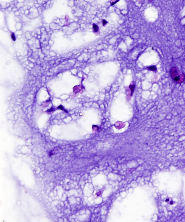 15 : Bone Soft Tissue Chondrosarcoma