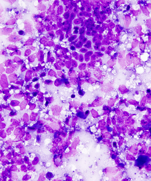 02 : Bone Soft Tissue Clear Cell Sarcoma