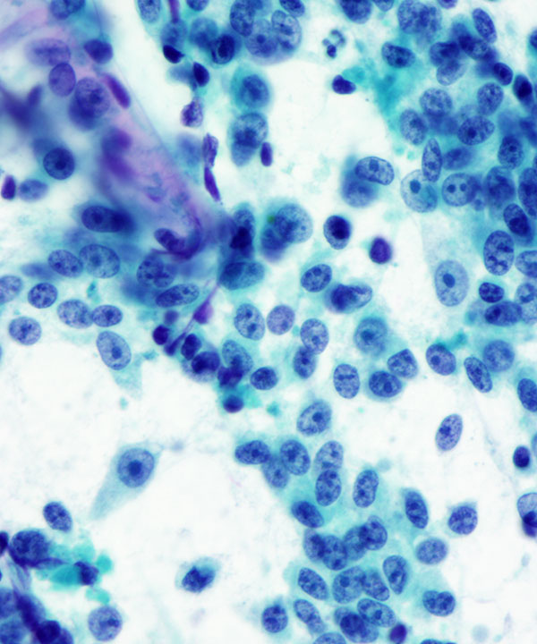 05 : Bone Soft Tissue Clear Cell Sarcoma