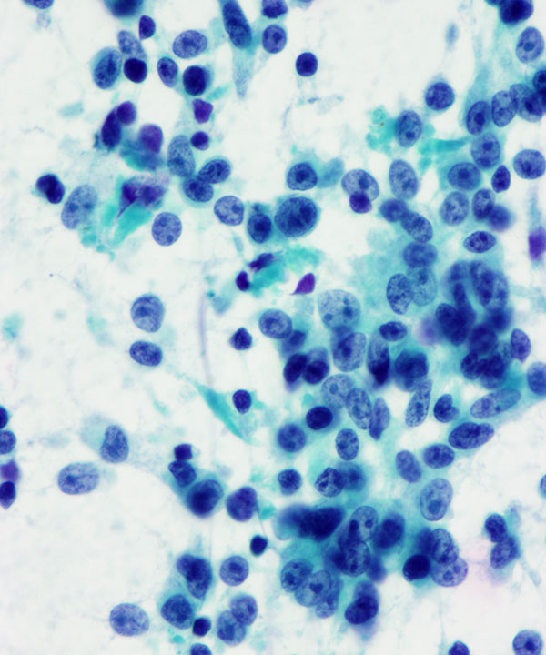 07 : Bone Soft Tissue Clear Cell Sarcoma