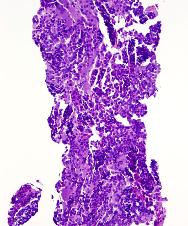 08 : Bone Soft Tissue Clear Cell Sarcoma