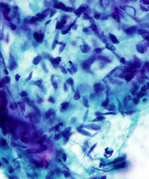 image showing 'Epithelioid Hemangioendothelioma'