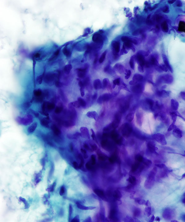 08 : BoneSoft Tissue Epithelioid Hemangioendothelioma