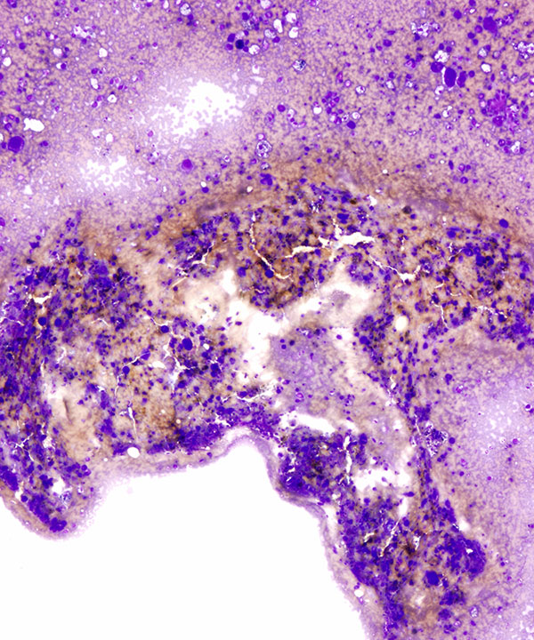 01 : Bone Soft Tissue Epithelioid Sarcoma